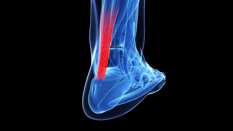 The Achilles Tendon